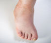 treatment for diabetic feet